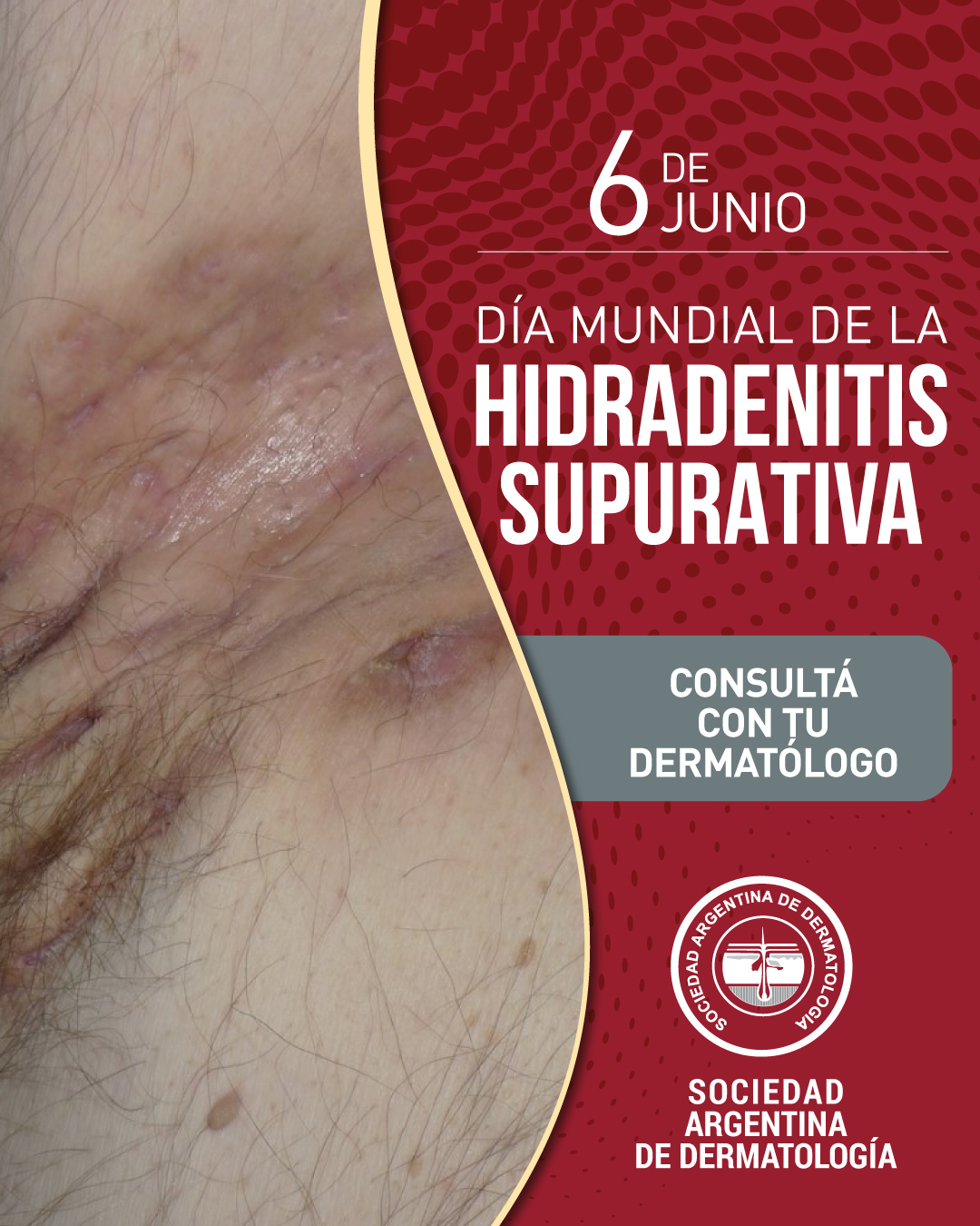 FLYER-DIA-MUNDIAL-HIDRADENITIS-SUPURATIVA-2026
