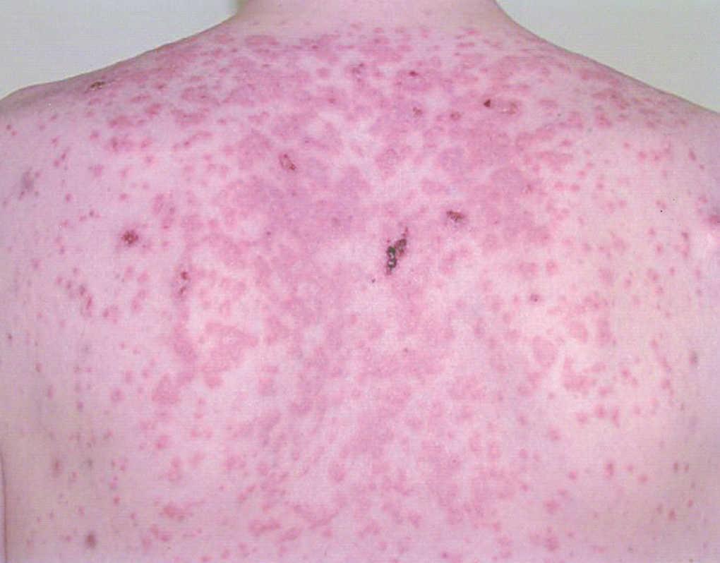 Lupus eritematoso: Actualización en diagnóstico y tratamiento – SAD