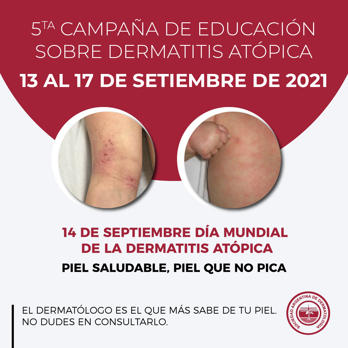 FLYER CAMPANA DERMATITIS ATOPICA