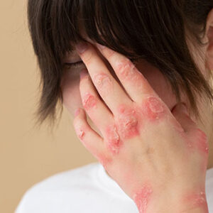 Curso online de Psicodermatología (No socios SAD)