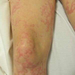 Curso online de Urticaria Crónica (No socios SAD)
